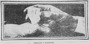 The treatment:  A photograph from the 14 July 1912 Richmond Times Dispatch depicts the placement of a madstone on a wound.  The photo was used to illustrate The Madstone Fallacy, a section of a full-page article on rabies.